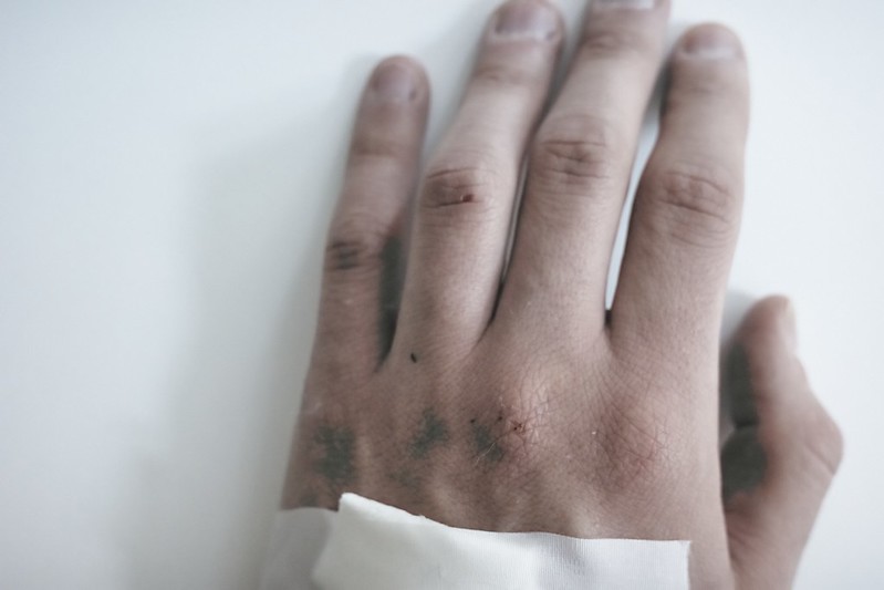 There’s a shortage of monkeypox vaccine. Could one dose instead of two suffice?