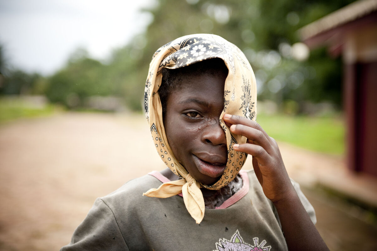 Stigma - a special Problem of NTDs